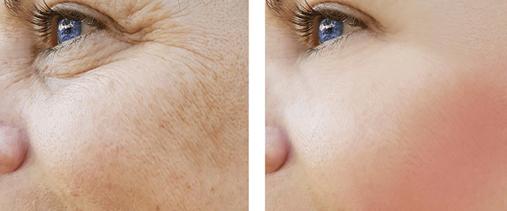 Top 5 Non-Surgical Skin Rejuvenation Treatments for a Youthful Glow