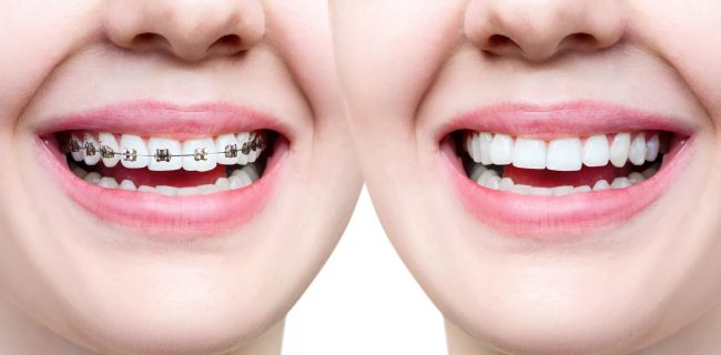 A Comprehensive Guide to Modern Orthodontic Treatments: Braces vs. Clear Aligners